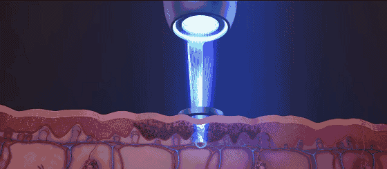 什么是光电治疗光电治疗适合什么样的瘢痕？_https://www.jmylbn.com_新闻资讯_第9张