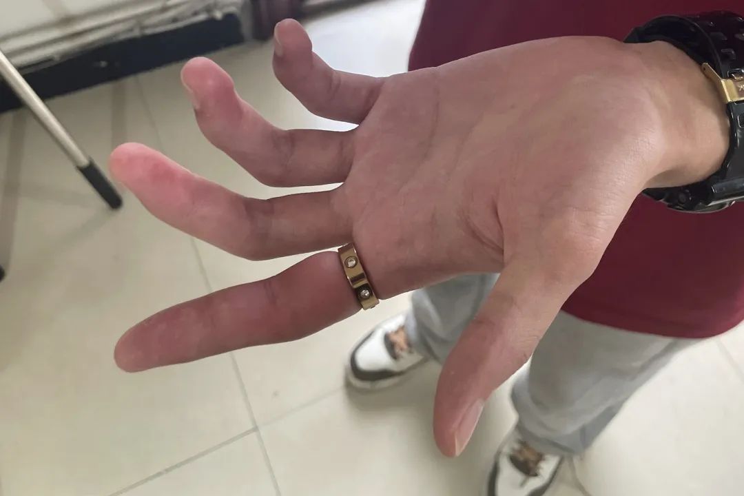 据男子介绍他将戴在左手无名指上的情侣戒指换到了食指上觉得太紧想摘下