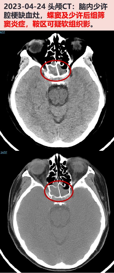 既往史:慢性鼻窦炎病史,04