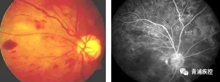 彩色眼底照相查什么【科普面对面】眼底一张照，疾病早知道_https://www.jmylbn.com_新闻资讯_第1张