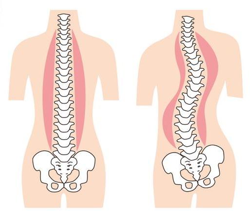 骨盆前倾,骨盆后倾)生理曲度的变化,属于脊柱的三维结构畸形,是儿童
