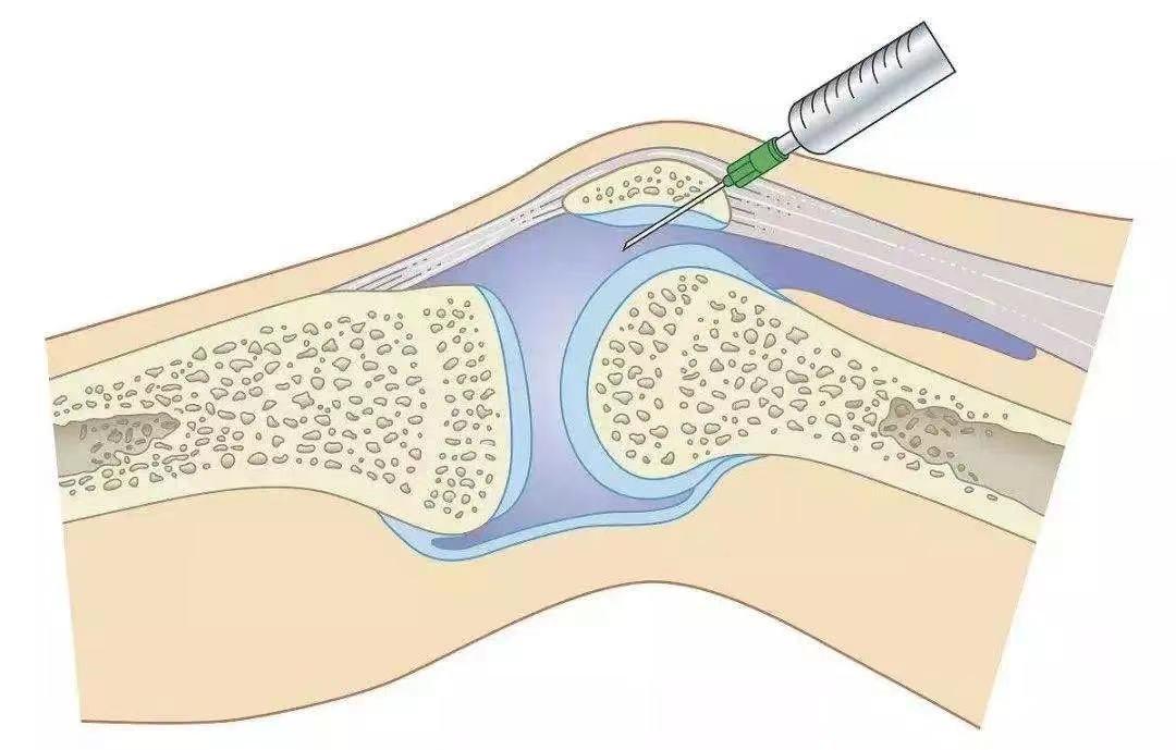 积液含有大量炎症因子,细胞,会侵蚀健康组织,结构,需及时通过关节穿刺