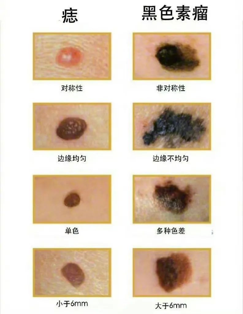 掌握以上特征恶性黑色素瘤便不难鉴别但对结构不良痣与早期恶性黑色素