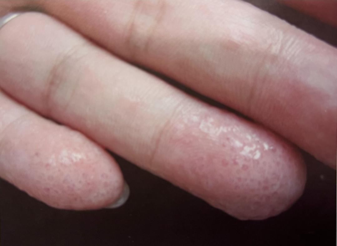 痒无比,如果有抠脚皮的习惯,致病真菌感染到手部皮肤,就可能引起手癣