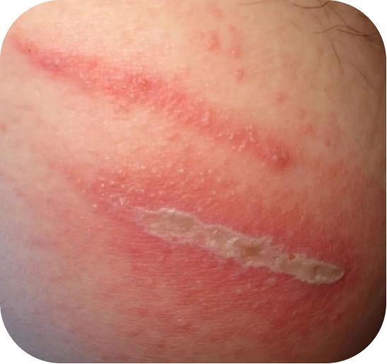 有一些在人体接触其体液后会引起急性红斑疱疹性损害的皮肤病,比如