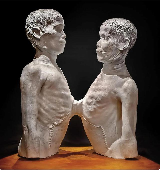 孟加拉双头男孩：上下串联，出生就上私人畸形秀，死后被盗尸解剖