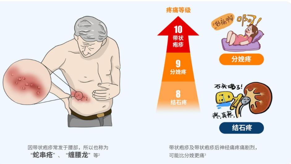 带状疱疹图片卡通图片