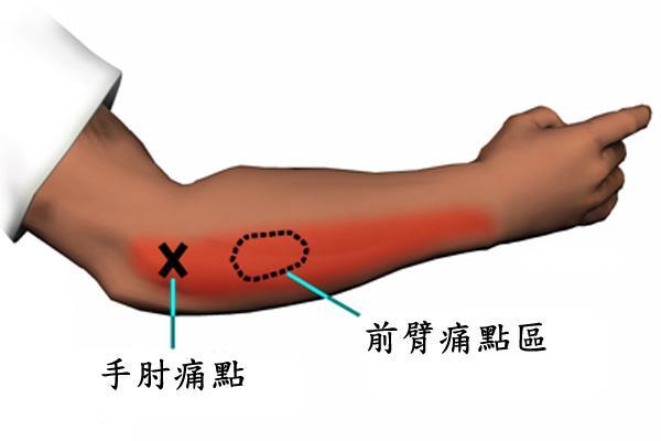 肘关节疼痛?这个检查可以帮您明确诊断