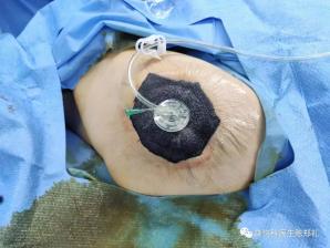 什么是负压引流管创面外用药物及敷料系列 —— 负压引流装置_https://www.jmylbn.com_新闻资讯_第1张