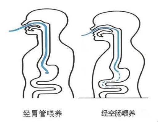 鼻肠管置入方法线路图图片