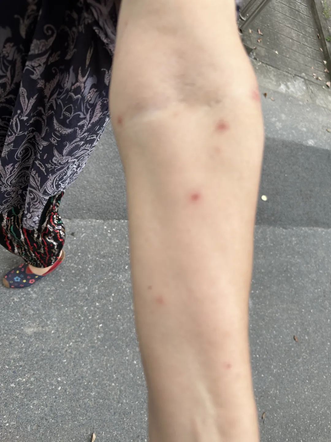 小区多位居民的四肢,面颈部等暴露部位皮肤出现突发性瘙痒和严重皮疹