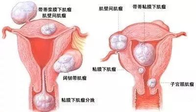 肌瘤钻怎么写子宫肌瘤、子宫腺肌症、子宫内膜异位症，是什么关系？_https://www.jmylbn.com_新闻资讯_第1张