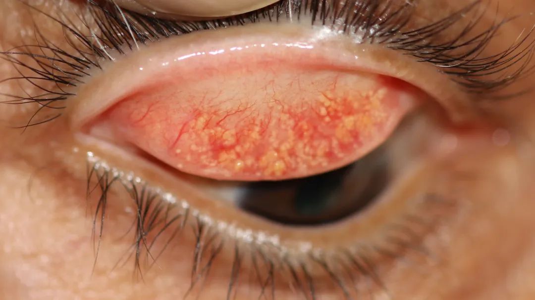 睑结膜上黄白色的结膜结石丨statpearls