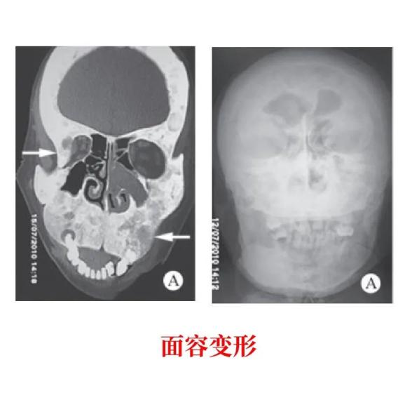 医生为什么叫买营养袋包装袋上有这类字的食物，肾友少碰_https://www.jmylbn.com_新闻资讯_第4张