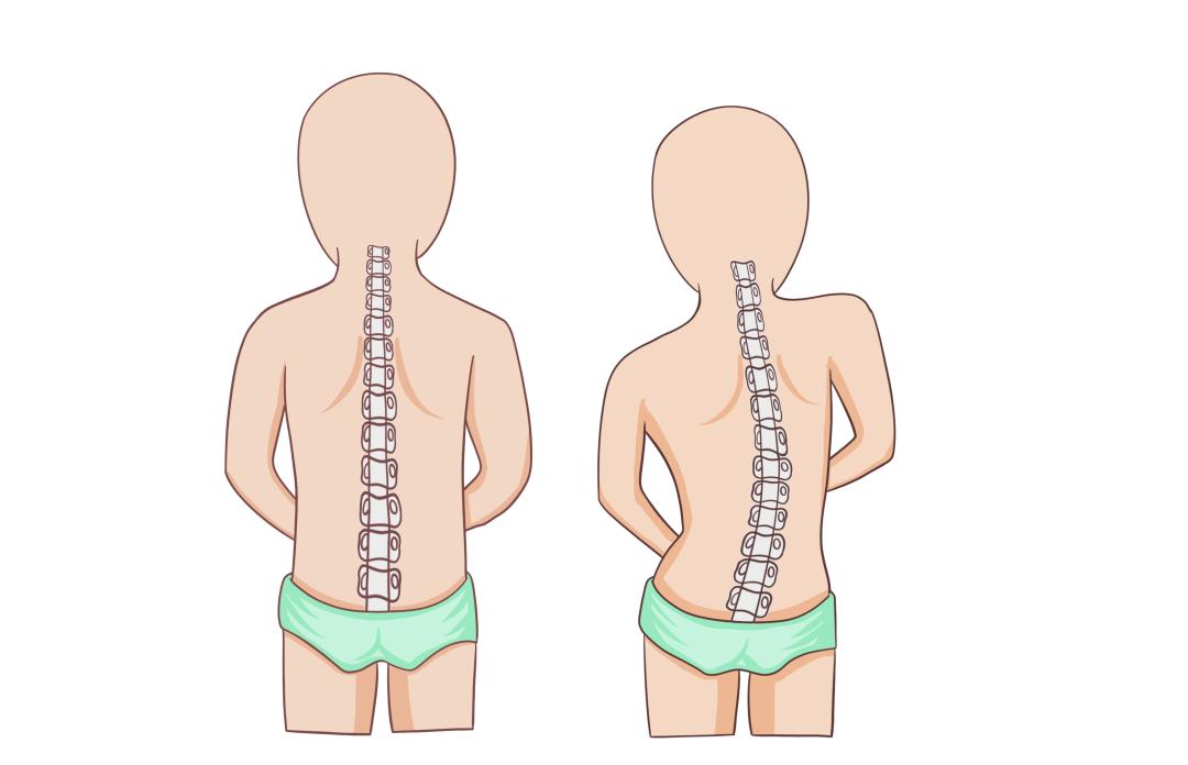 孩子脊柱侧弯啥原因?咋处理?