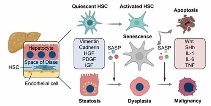 nash→纤维化→异型变→肝细胞肝癌进程中肝星状细胞衰老的动态悲化