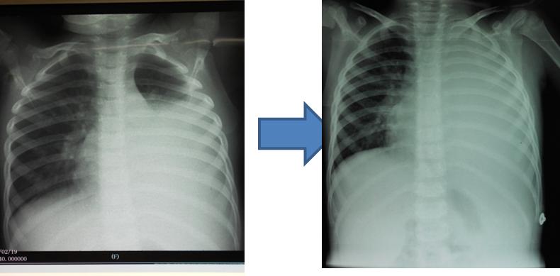 学龄期学龄前期儿童,持续高热时间长,咳嗽剧烈,肺部拍片有大片的阴影