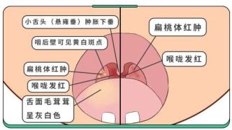 娃感冒咳嗽后有这种症状，不抓紧治，小心变急性咽炎