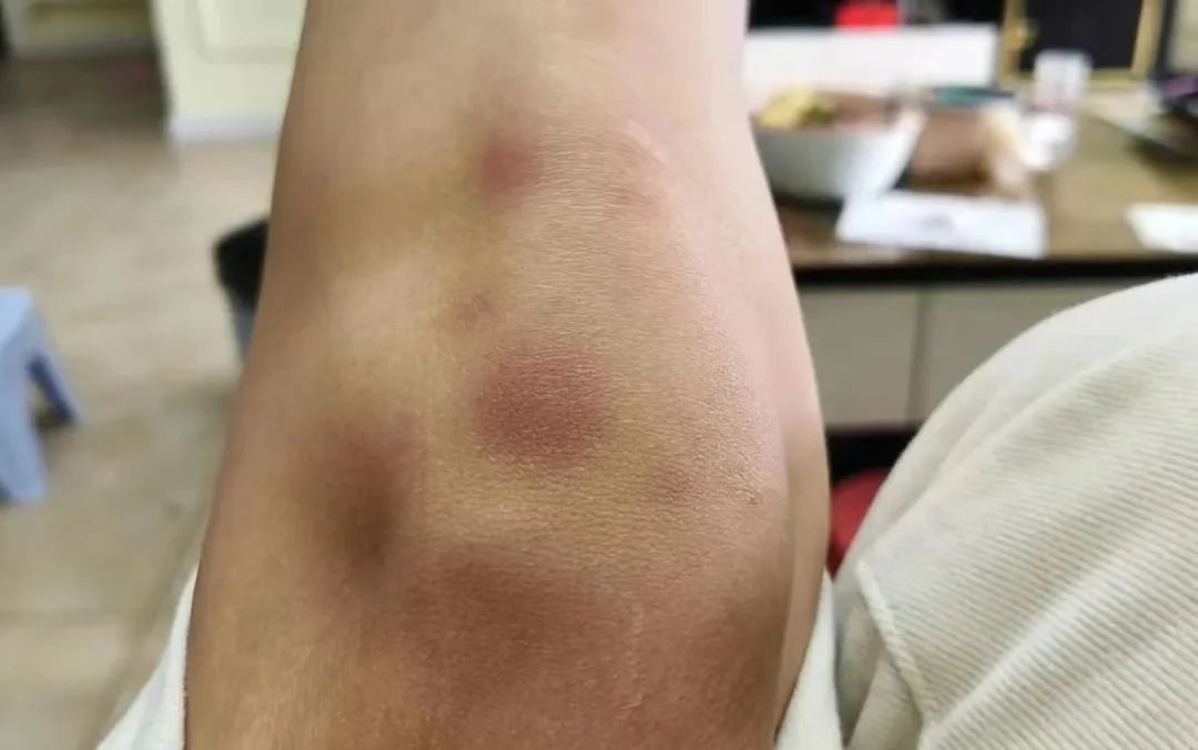 的膝盖上有了大大小小的淤青同行的表姐看着心疼便将手包垫在她的膝盖下刘婉膝盖的淤青游客队伍中一对医生夫妇也赶来帮忙