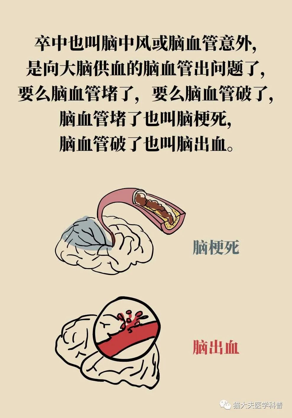 世界卒中日｜远离卒中，必须知道的11件事_澎湃号·湃客_澎湃新闻The Paper
