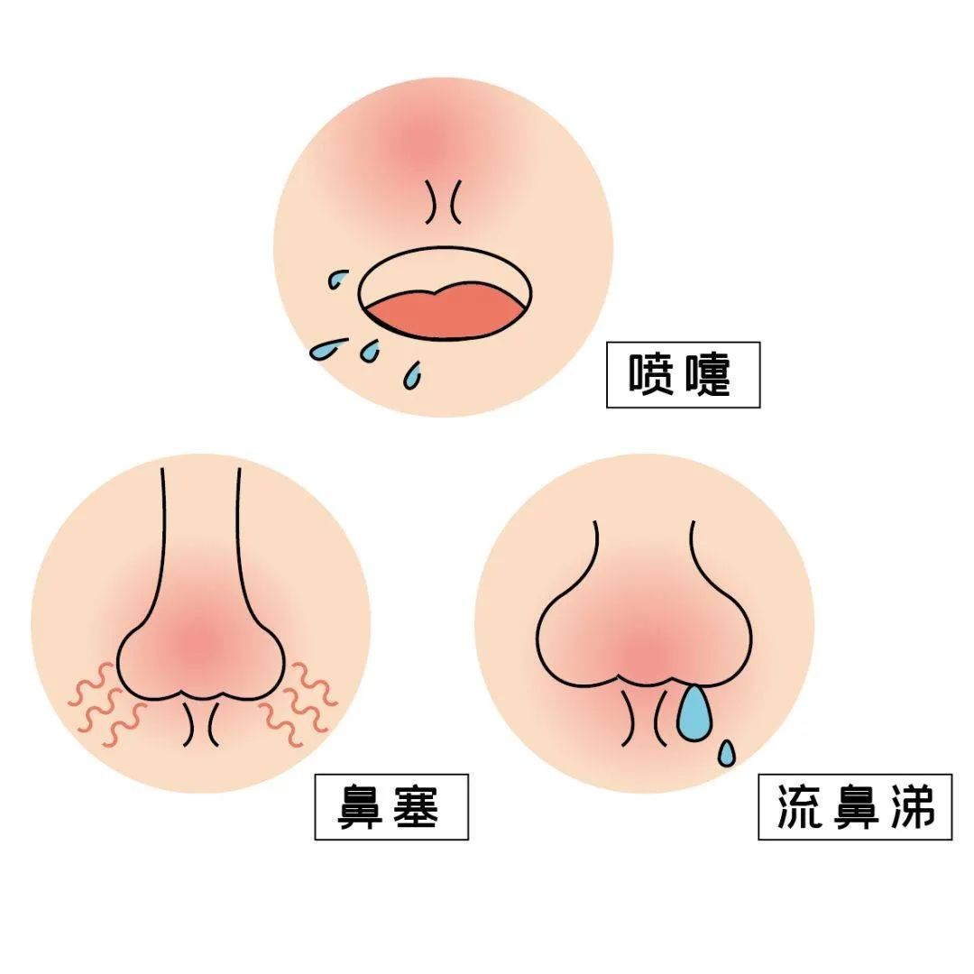 程度輕重不一,可表現為間歇性或持續性,單側,雙側或兩側交替性鼻塞