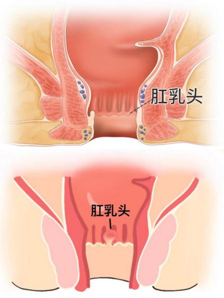 肛门痔疮图 脱肛图片