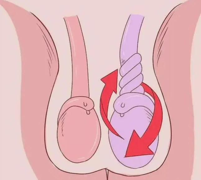 睾丸出现扭转的原因,除了睾丸及其附件的先天性解剖异常,比如睾丸鞘膜