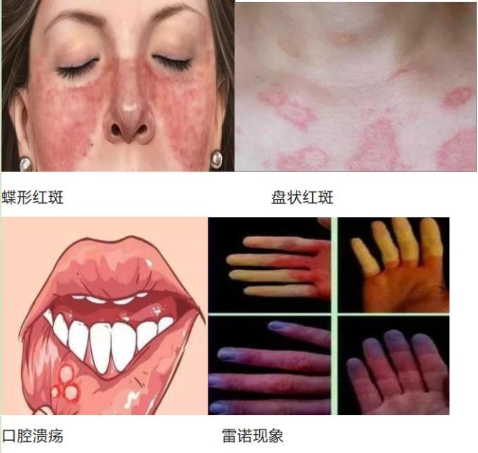 发烧,乏力系统性红斑狼疮有哪些症状?q3