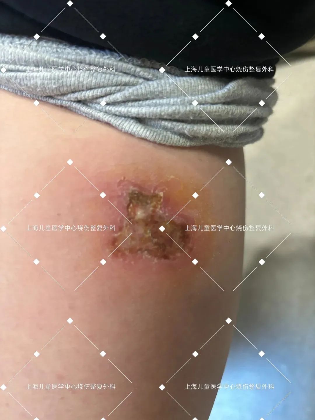 儿医小课堂 146 | 电热毯可能成"梦中杀手"?警惕冬季低温烫伤