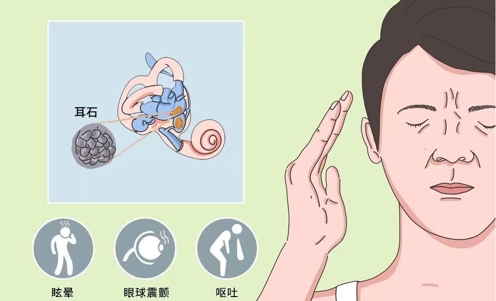 有一种天旋地转,居然是耳朵里的石头在作祟?
