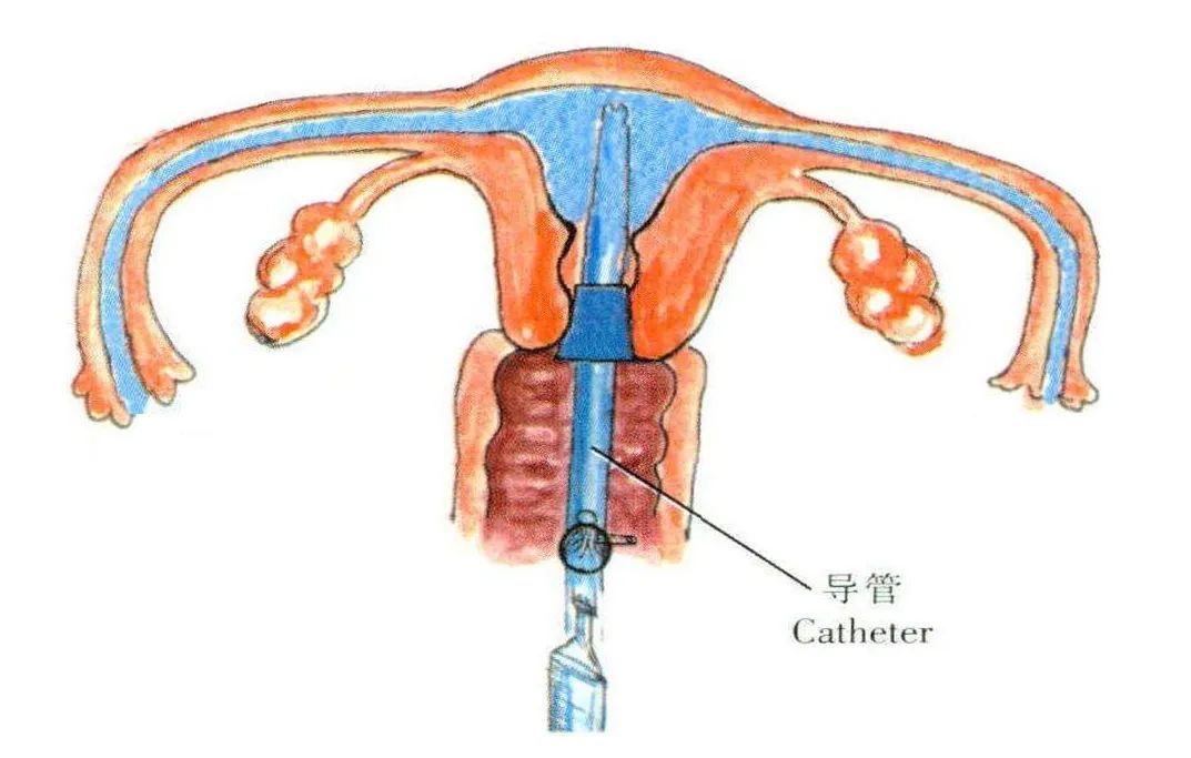 宫腔灌注,让子宫内膜不再是怀孕"拦路虎"_澎湃号·湃客_澎湃新闻-the