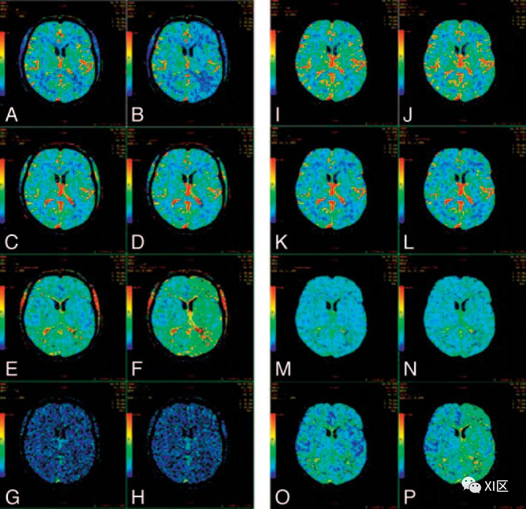 脑灌注成像颜色解读图片