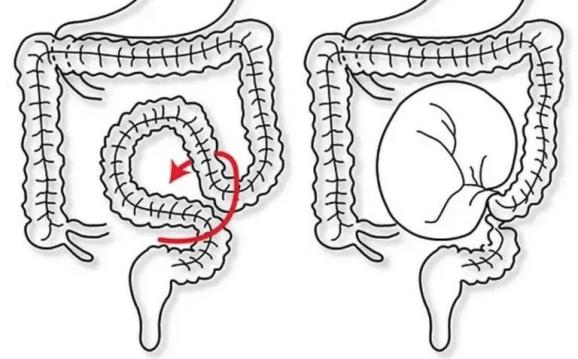 乙状结肠扭转的发生和乙结肠的解剖结构有关,由于乙结肠在腹腔里活动