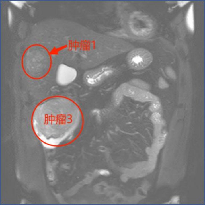 公卫·救治丨45岁男子肝脏内有三个肿瘤!