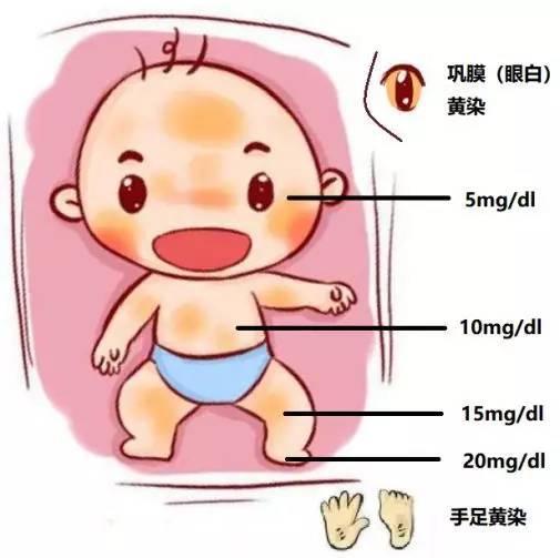 【健康】认识新生儿黄疸