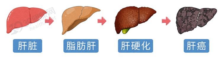 進而影響肝細胞對脂肪酸的分解和代謝,形成酒精肝,脂肪肝