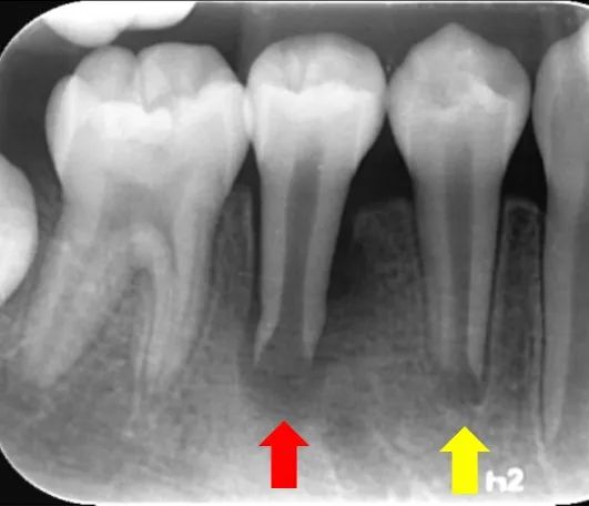 黃色箭頭所指牙齒健康;紅色箭頭所指牙齒出現根尖炎症,可見牙根周圍大