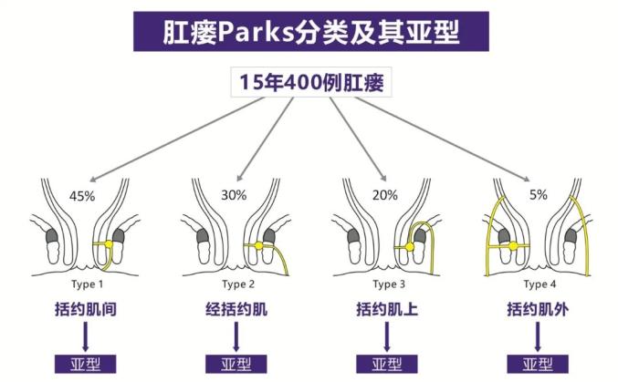 马蹄形肛瘘图片图解图片