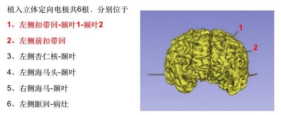 視頻腦電圖監測(veeg)是通過電極記錄從顱內經顱骨等傳導至頭皮的生物