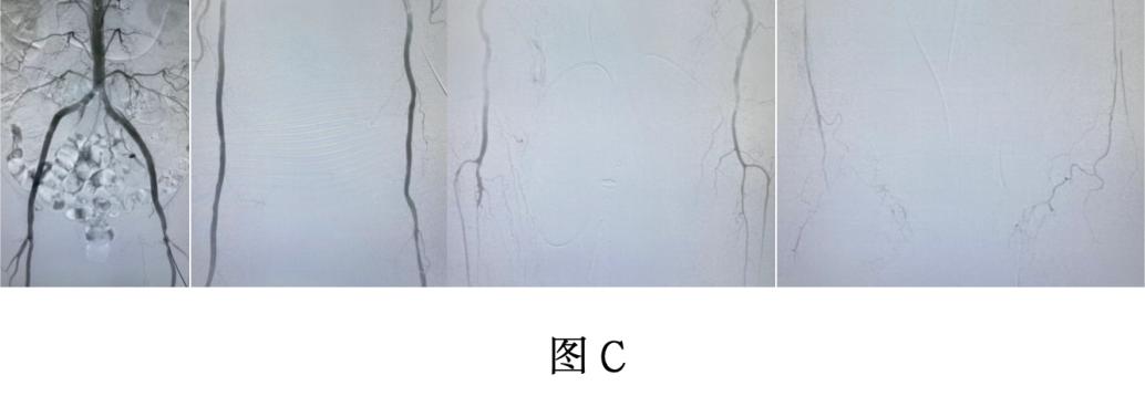 術後造影:雙側髂動脈,股動脈,膕動脈及膝下動脈顯影,血流恢復(圖c)術