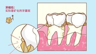 牙医解答|牙结石是如何形成的