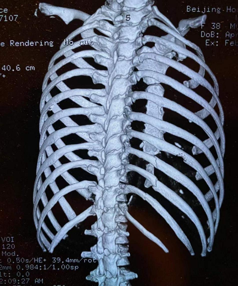 肋骨三维成像图片图片