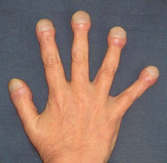 肺癌对人体到底都有哪些危害,为什么手指粗皮肤痒都能和肺癌相关