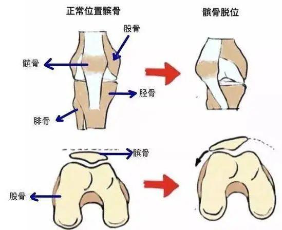 健康 髌骨脱位是什么?