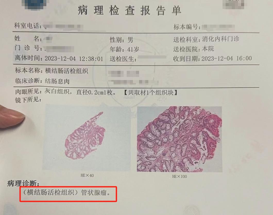 研究显示,腺瘤切除预防肠癌成功率为76%左右有时我和我爸