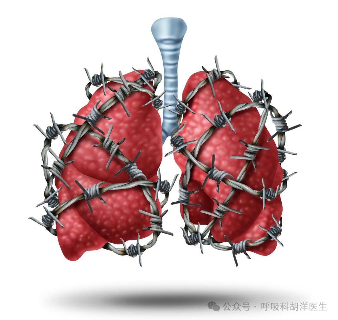 我肺上除了有结节,还有支气管扩张,年轻时重症肺炎留下的后遗症原创