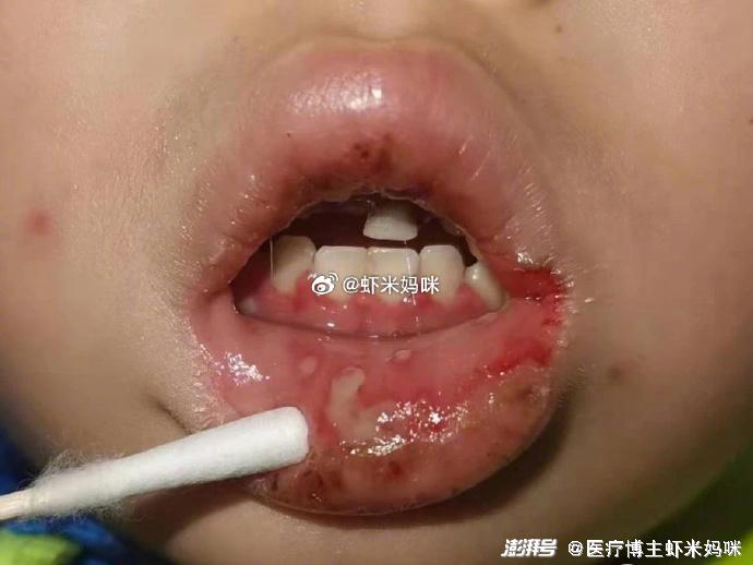 疱疹性口腔炎, 疱疹性咽峡炎,唇疱疹,如何分辨?