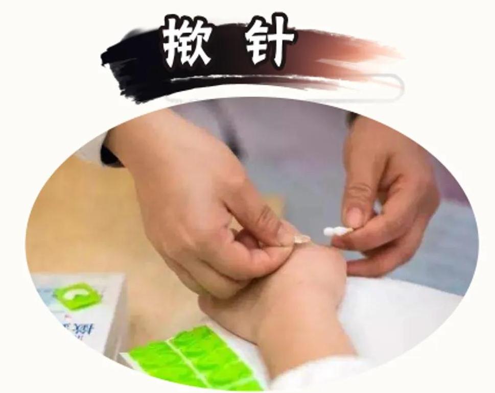 外用中药药膏等,还可以应用耳穴压丸,耳针,穴位埋针等治疗减轻症状