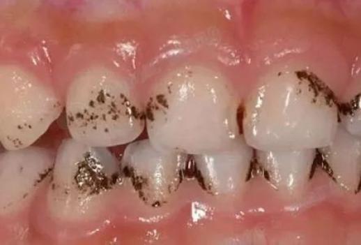 女性健康 | 牙齿上出现黄黄的,黑黑的物质,是蛀牙吗?