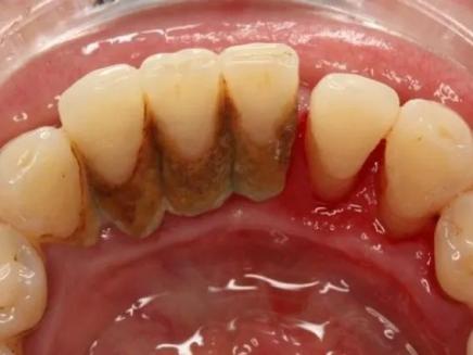 女性健康 | 牙齿上出现黄黄的,黑黑的物质,是蛀牙吗?